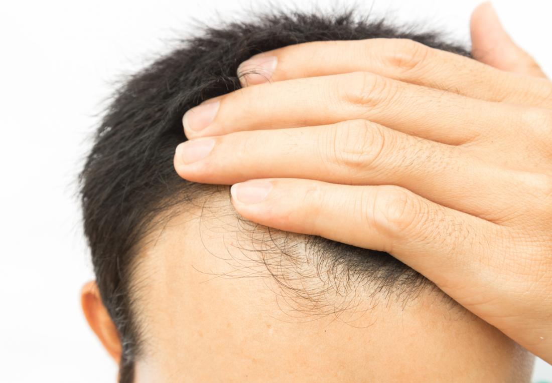 Biotin Hapı Saç Dökülmesini Engeller mi?