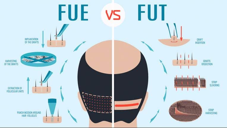 Saç Ekimi Yöntemleri: FUE ve FUT Arasındaki Farklar