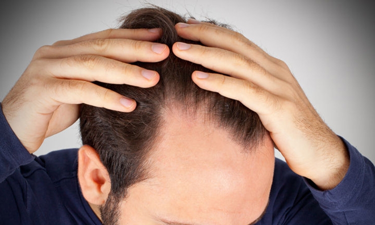 Saç Dökülmesine Karşı Doğal Tedavi Yöntemleri