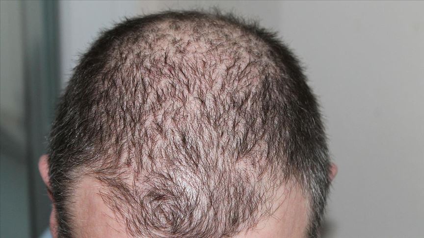 Saç Ekimi Ameliyatının Riskleri ve Yan Etkileri