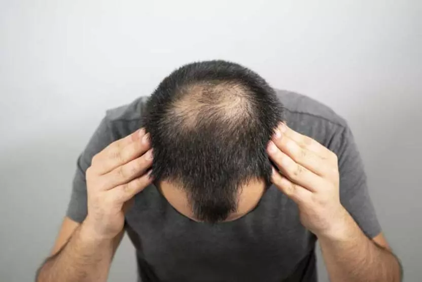 Saç Ekimi İle Saç Dökülmesi Tedavisi