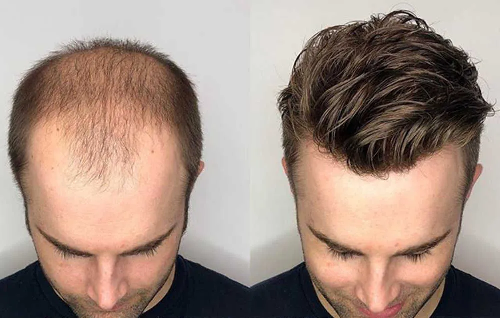 Saç Ekimi vs Saç Protezi Hangisi Daha İyi?