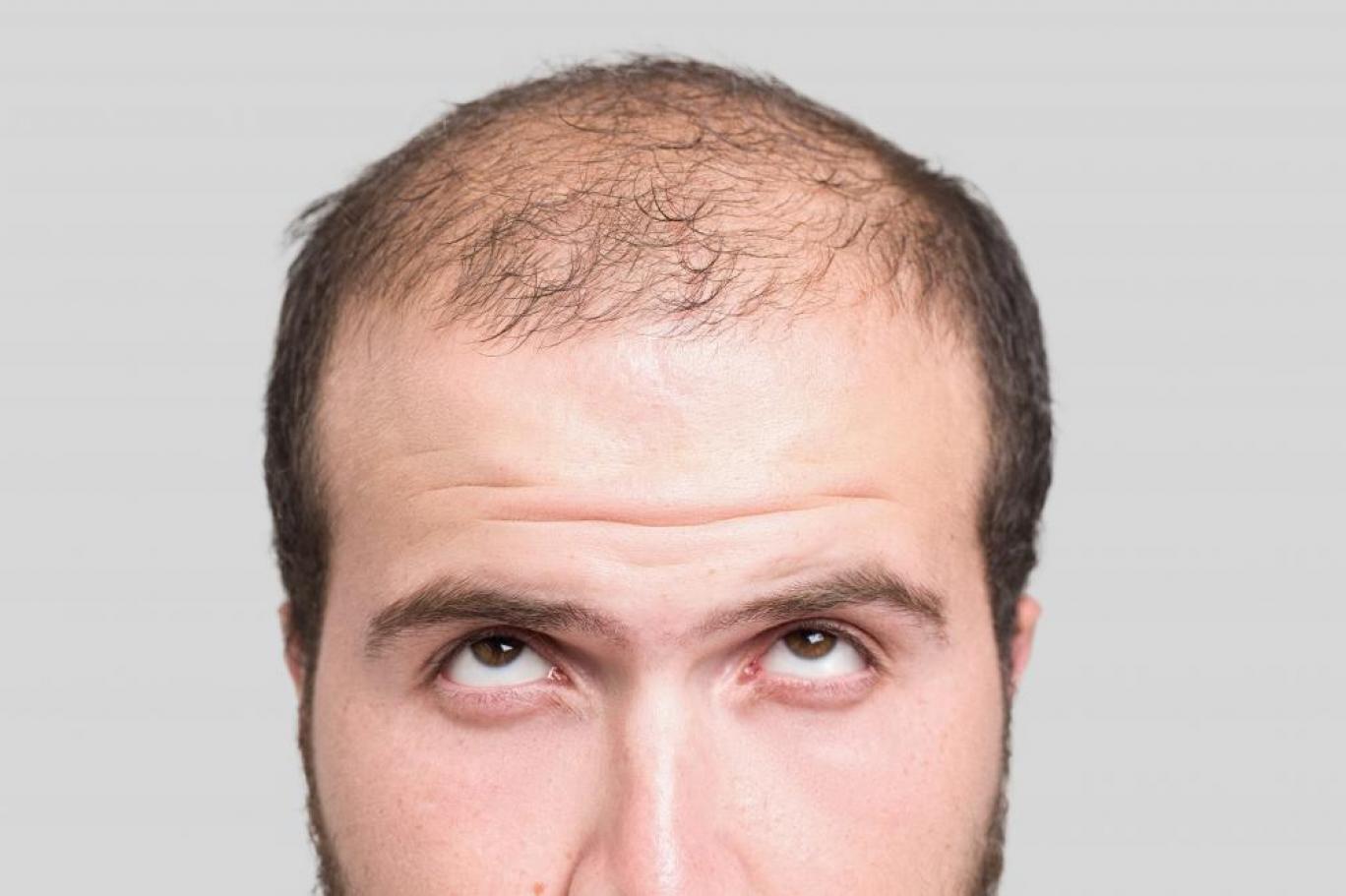 Saç Dökülmesini Önlemenin Yolları Nelerdir? Uzmanlar Ne Diyor?