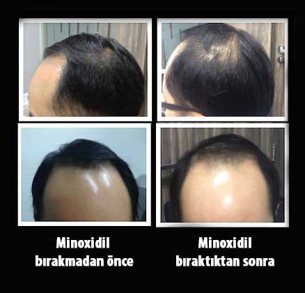 Saç Ekimi Sonrası Minoxidil Kullanımı ve Etkileri